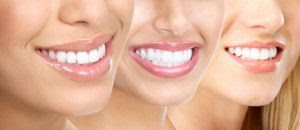 Tẩy trắng răng có hiệu quả không?
