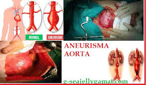 Menilik Aneurisma Aorta, Penyakit Menilik Aneurisma Aorta, Penyakit