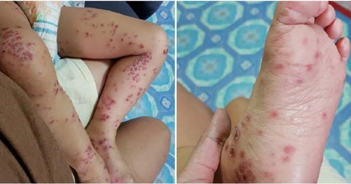 A Mother Warns Against Hand-foot-and-mouth Disease (And How To Avoid It