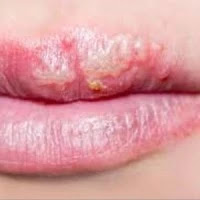 Lips Allergy Treatment And It S Secured Article