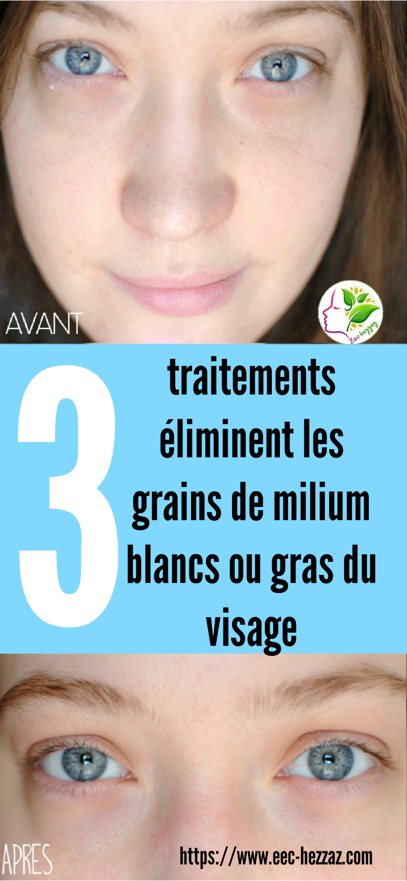 3 traitements éliminent les grains de milium blancs ou gras du visage