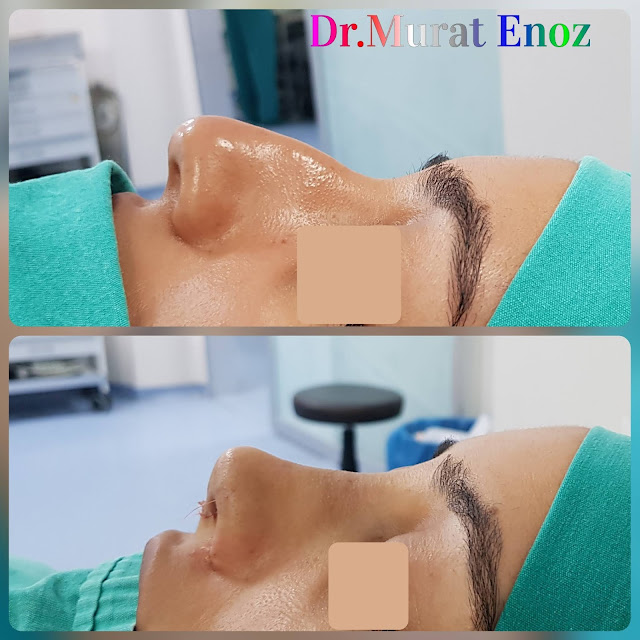 femal nose job,rhinoplasty operation in istanbul,nose job for women,thick skinned nose aesthetic,Ethnic rhinoplasty,nose job for thick skinned nose,