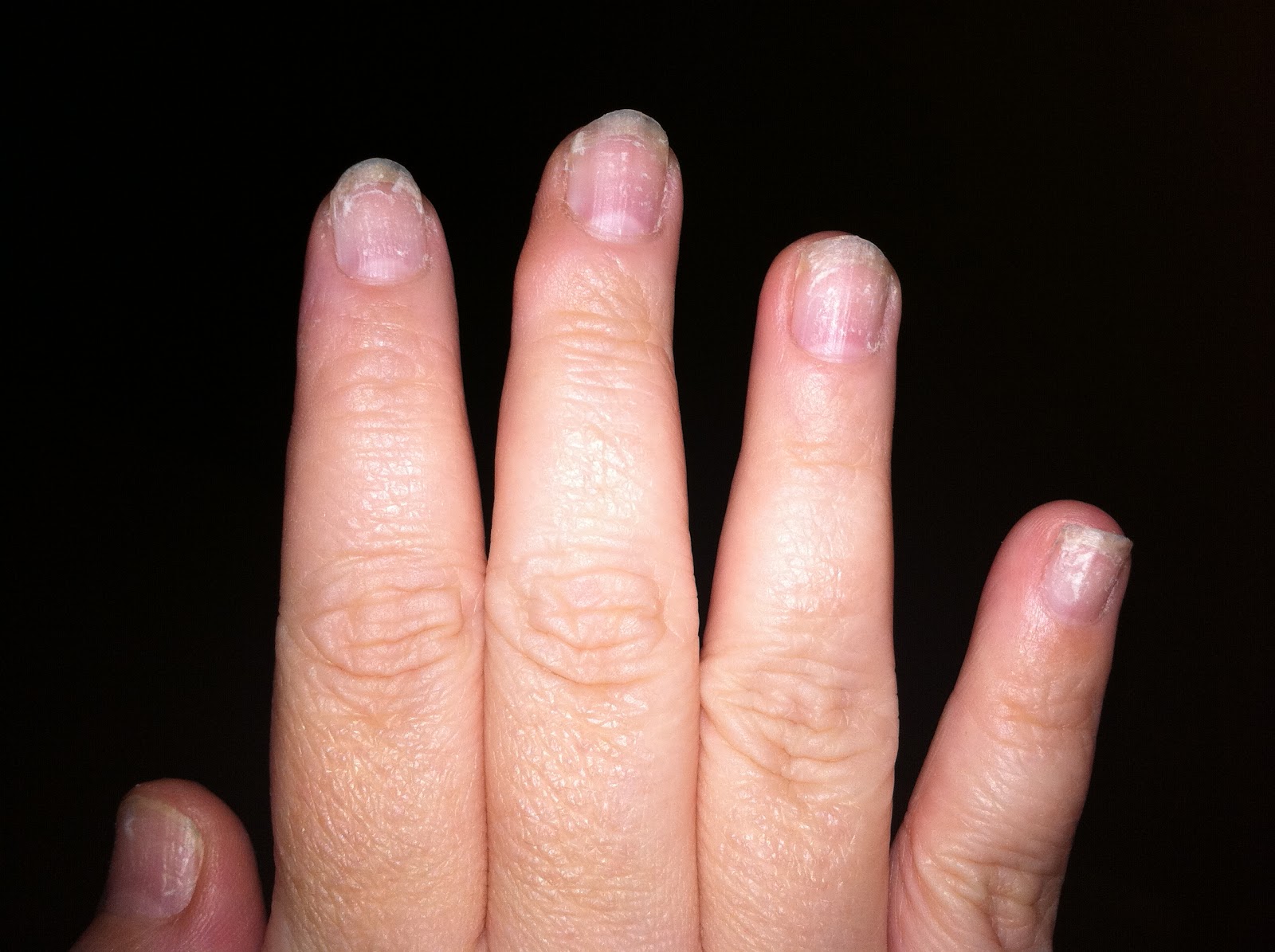 Tiny plastic fingernails After glue on full cover nail removal