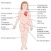 Turner syndrome: Characteristics and complications
