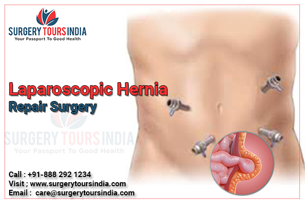 Laparoscopic Hernia Repair Surgery India
