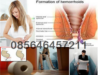 Obat dan Salep Hemorrhoid (Wasir)