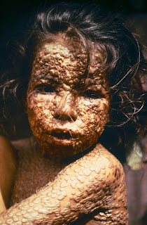 Çiçek hastalığına yakalanmış Bangladeşli bir kız (1971)