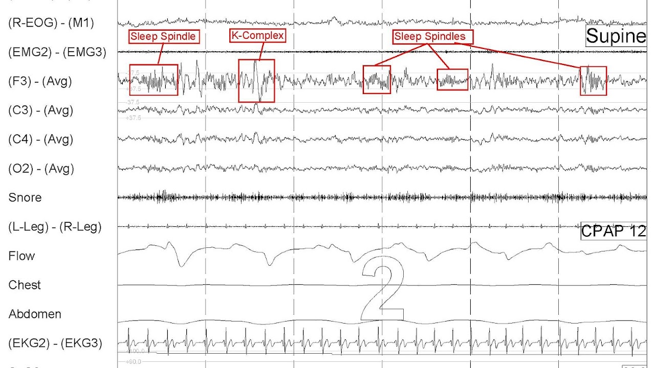 K Complex Sleep Sleep Choices