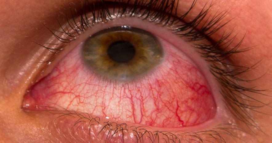 Conjunctivitis Pink Eye Symptoms Causes Treatment More My XXX Hot Girl