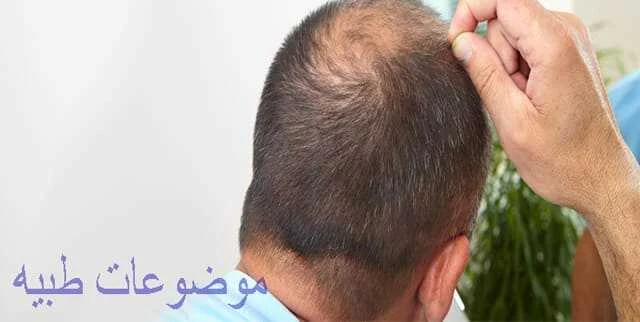 علاج تساقط الشعر الوراثى للرجال بالاعشاب 