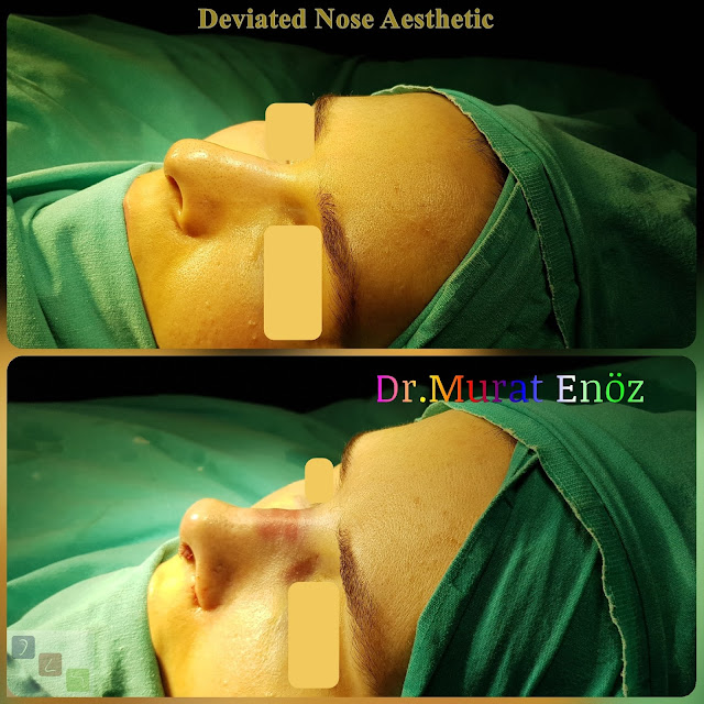 Deviated Nose Aesthetic Turkey
