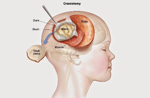 Craniotomy