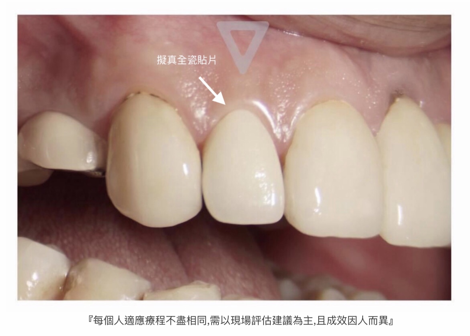 牙周病是什麼？專家超詳細解說牙周病治療方式 - 璽恩牙醫診所 Shine Smile Clinic