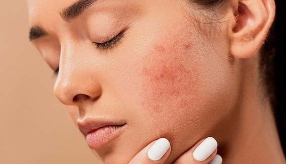 acne-prone-skin-treatment acne-prone-skin-treatment