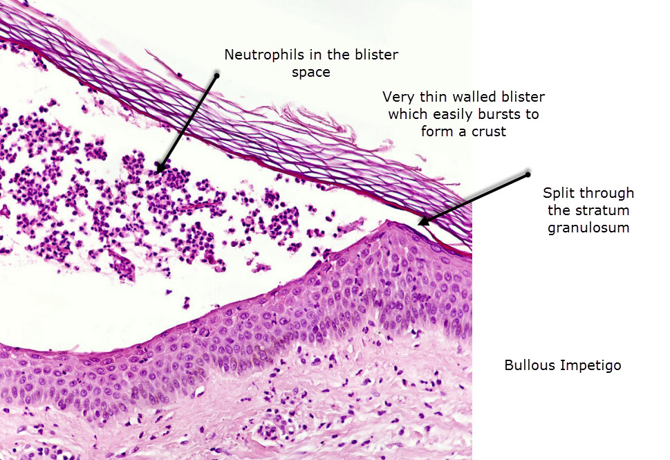 Dermatopathology Made Simple Inflammatory Vesicles Or Blisters
