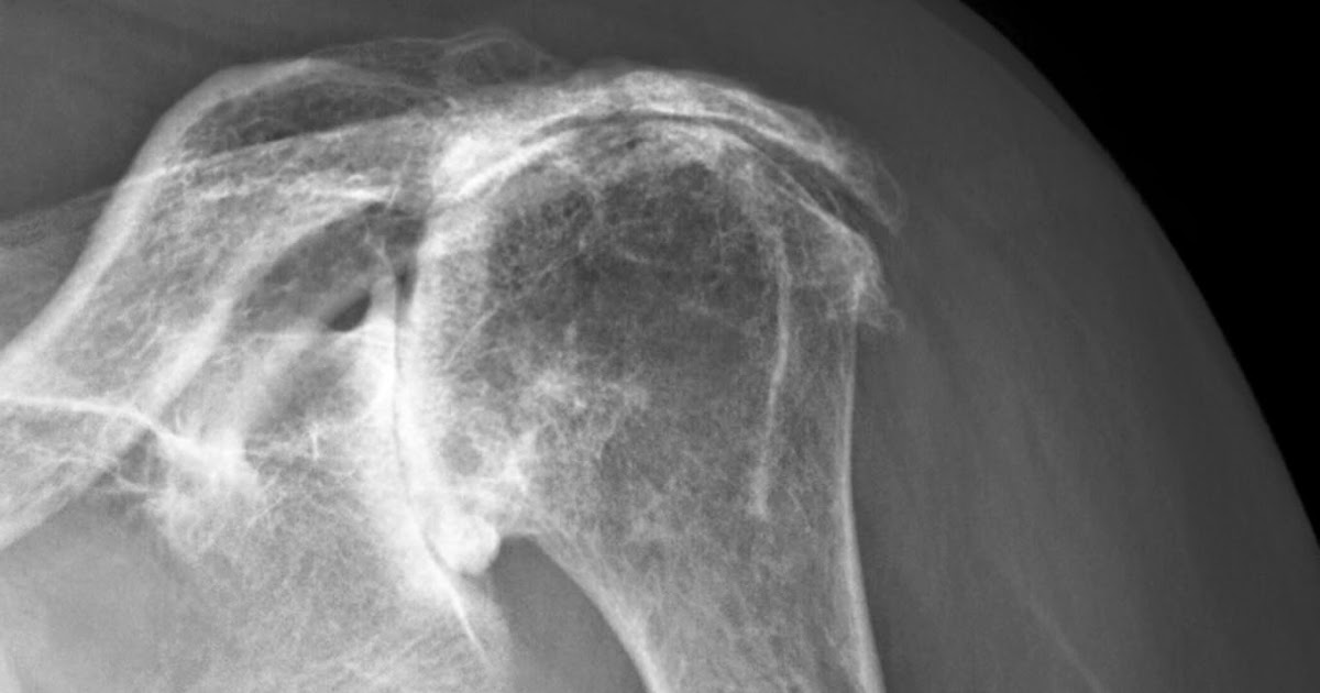 Shoulder Arthritis / Rotator Cuff Tears causes of shoulder pain Cuff