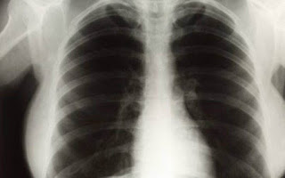 Σύστημα τεχνητής νοημοσύνης της Google μελετά ακτινογραφίες πνευμόνων και βγάζει αξιόπιστα συμπεράσματα