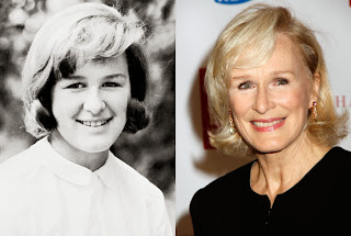 Glenn Close Plastic Surgery Before and After Photo