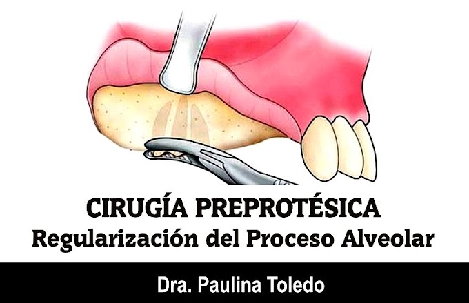 CIRUGÍA PREPROTÉSICA: Regularización del Proceso Alveolar - Dra. Paulina Toledo