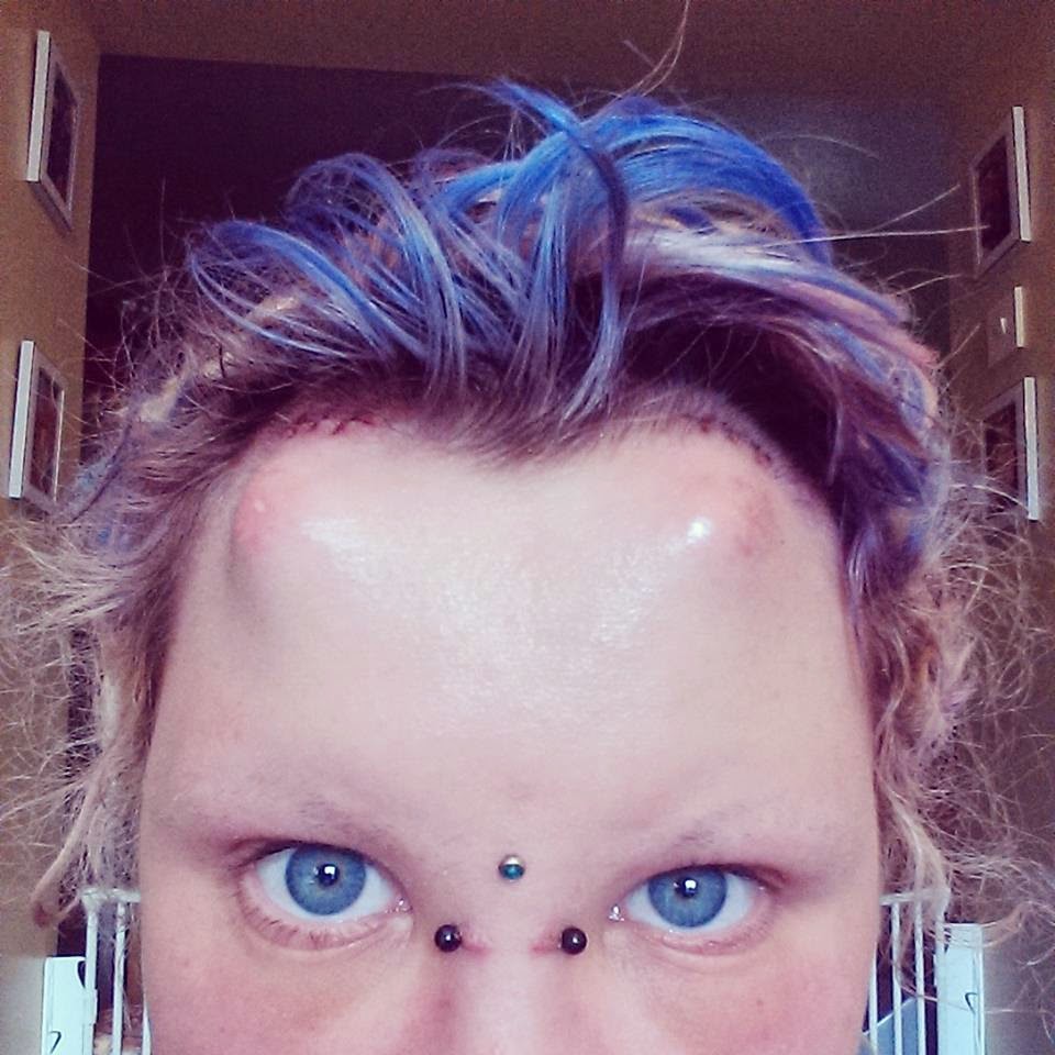 Olive Elf Sub dermal horn implants! Healing / procedure