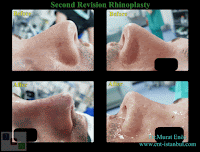 Secondary nose job istanbul,2nd Revision Male Rhinoplasty,revision nose aesthetic surgery,