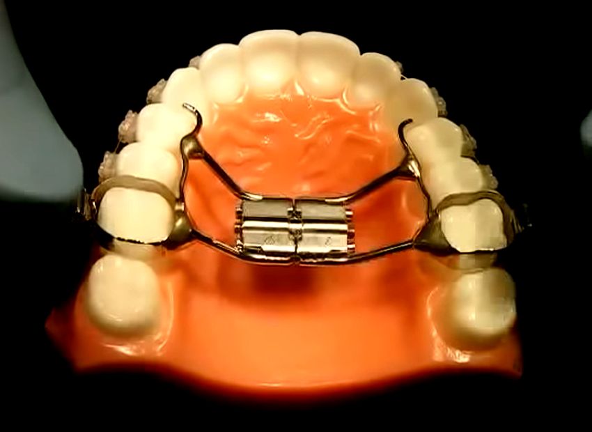 JAW EXPANDER How to Turn Steve Yang