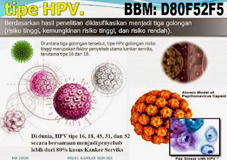 Hilangkan kutil di kelamin, Anus, Selangkangan, Dengan obat sembuh mujarab