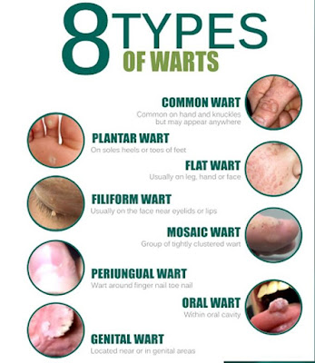 hpv warts skin tags private parts hpv warts skin tags private parts