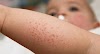 Bunda! Berikut Ini Mengatasi Alergi Protein Susu Pada Anak