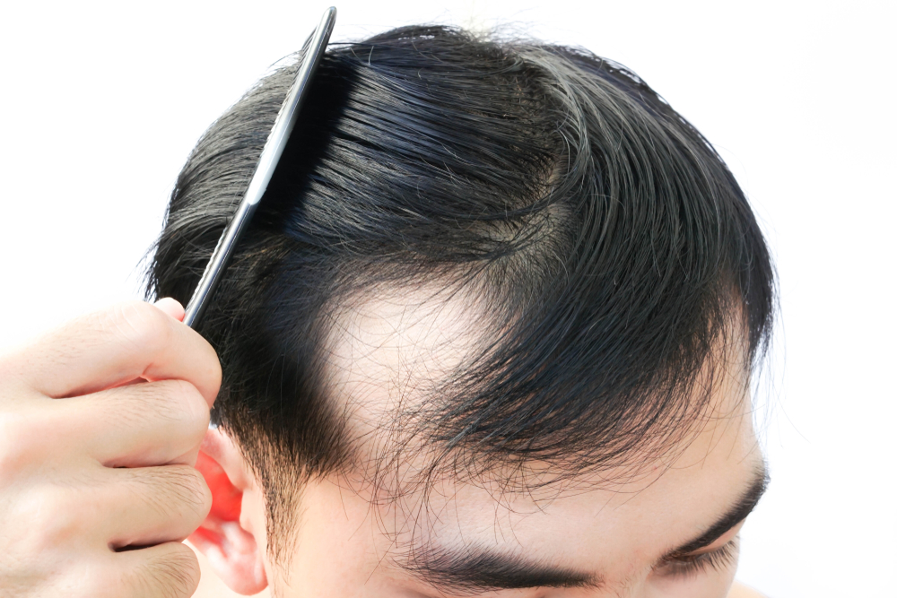 HOW TO STOP EARLY STAGES OF BALDNESS AND THINNING HAIR THE MALE