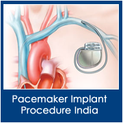 Pacemaker Implantation in India