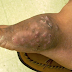 Mycetoma | Madura foot disease | neglected tropical disease