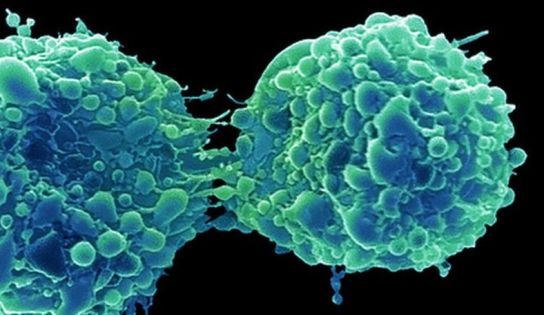 Bladder Cancer 'Attacked And Killed By Common Cold Virus'