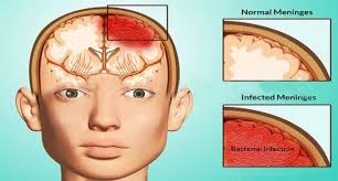 menenjit hastaligi ve tedavisi