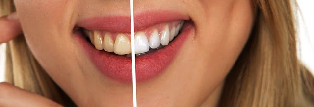 Teeth Whitening Treatment