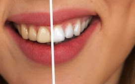 3 Must-Follow Tips Before and After Your Teeth Whitening Treatment