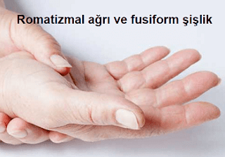 Romatizmal semptomları Romatizmal ağrı ve fusiform şişlik