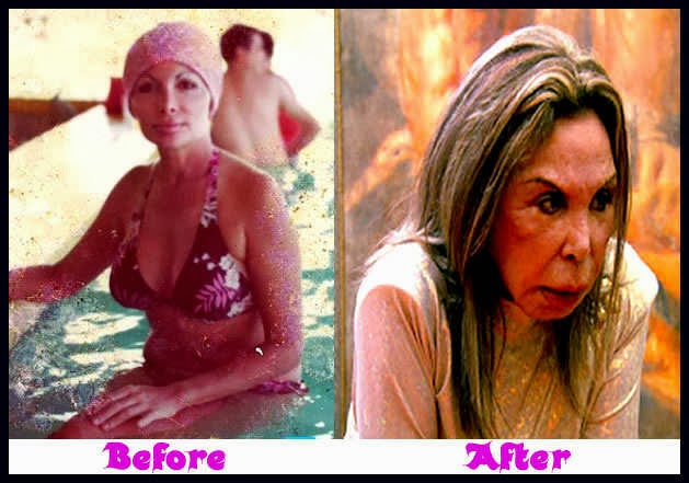 Elsa Patton Before Plastic Surgery