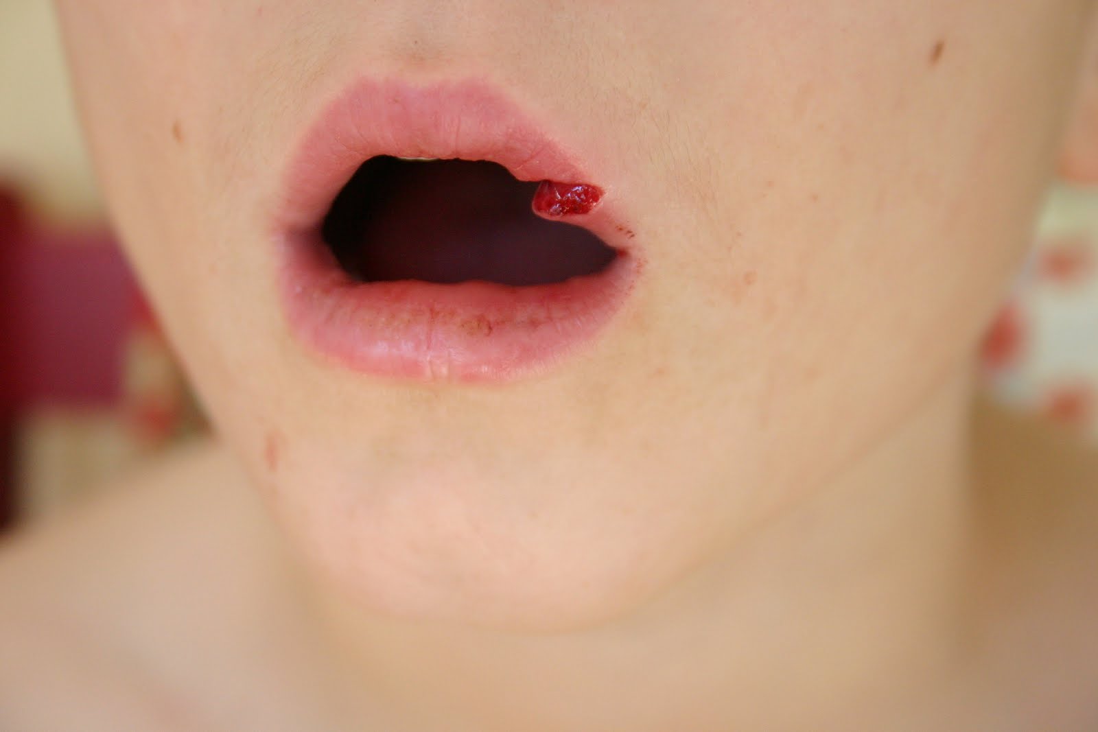 my-perspective-kyle-s-busted-lip-1-22-11