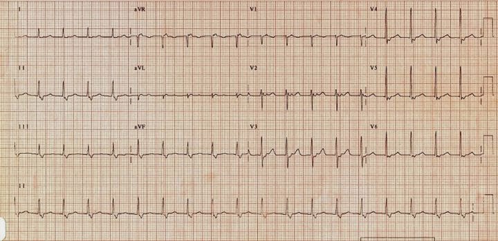 Medical Addicts: AV NODAL RE - ENTRANT TACHYCARDIA (AVNRT)