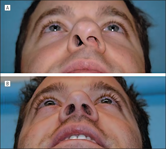 WiKi HEALTH CARE When the nose bones are curved