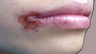 Angular Cheilitis Overnight Cure Home remedy