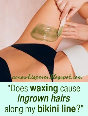 Does waxing cause ingrown hairs?