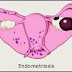Causes and Symptoms of endometriosis Cysts
