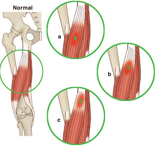 Letter Classification on Site of Muscle Injury Letter Classification on Site of Muscle Injury - El Paso Chiropractor