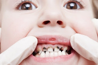 Trẻ em thay bao nhiêu cái răng-3