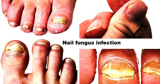 Nail fungus infection: Symptoms, Causes, Diagnosis and Treatment.