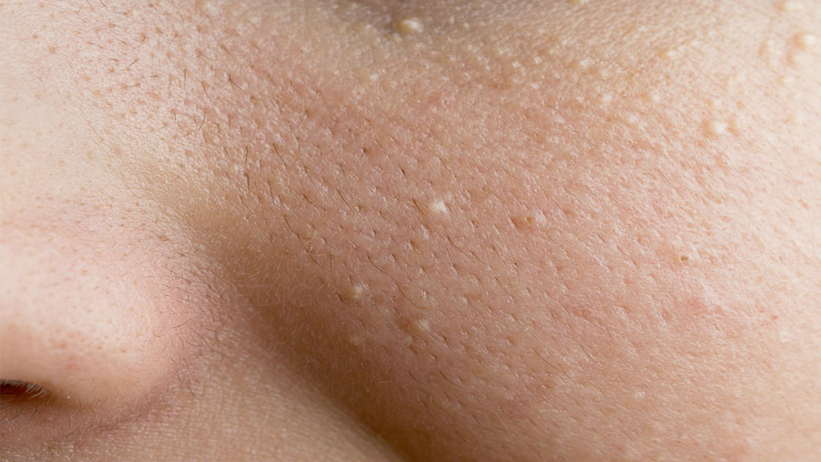 Movers Move Milia Removal at Home