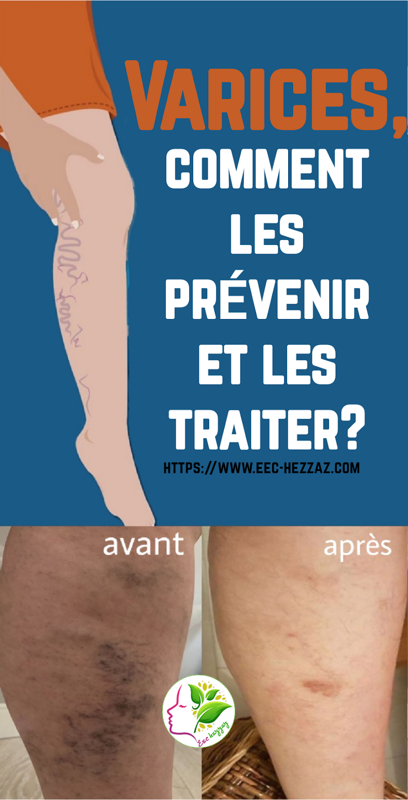 Varices, comment les prévenir et les traiter?