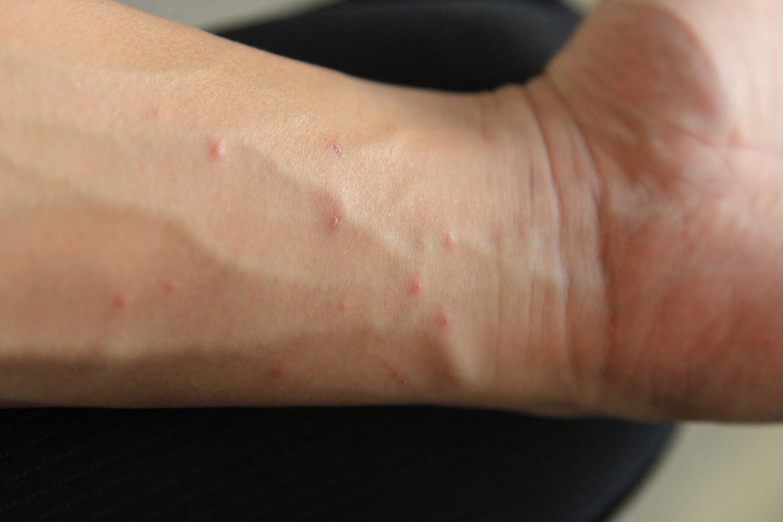 scabies on hands | Best Scabies Treatment: Dr. Scabies ...